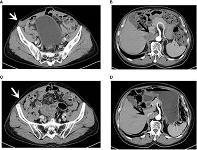 Case report: Bullous pemphigoid associated with sintilimab therapy for pMMR/MSS colorectal cancer